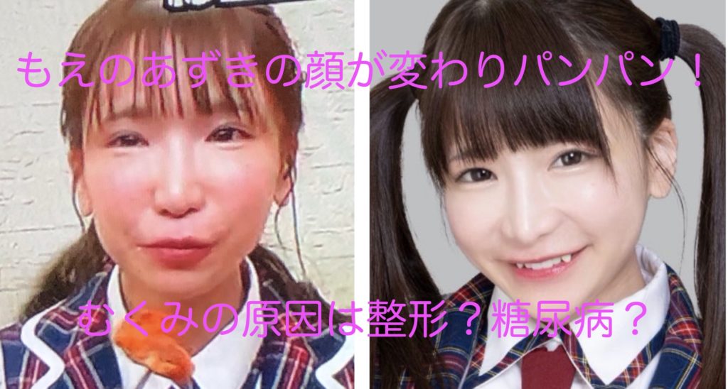 もえのあずきの顔が変わりパンパン むくみの原因は整形 糖尿病 Sukima